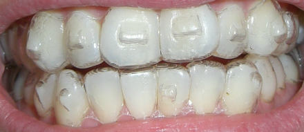 What are some good message boards about Invisalign?